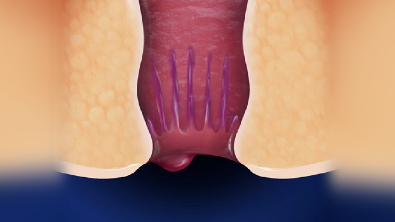 hemorroides y cancer anal