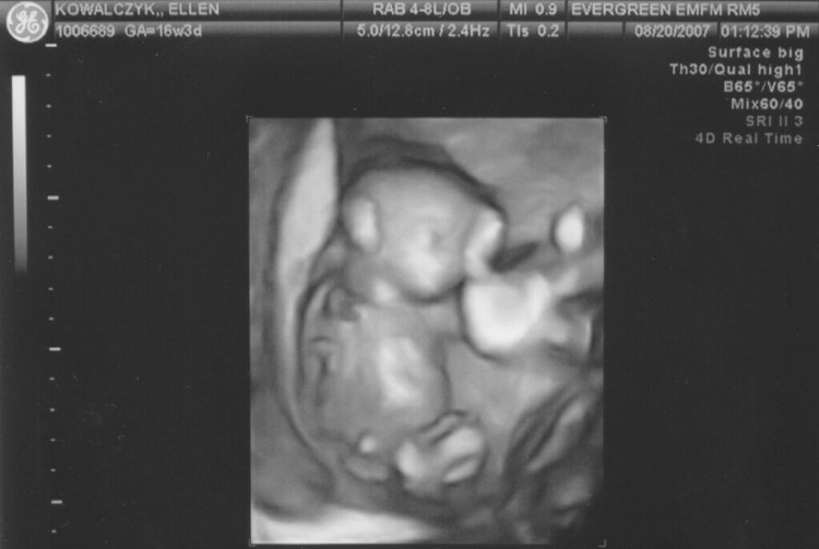 Ella Kowalczyk (baby A) 3D - 16 weeks - Here's Ella in a 3D … - Flickr