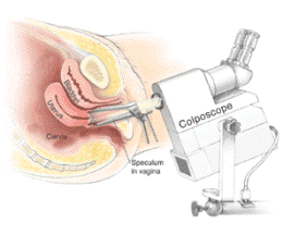 Colposcopy - El Segundo, CA: Womens Clinic LA