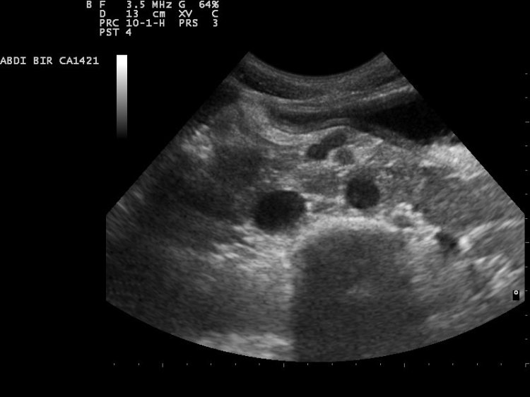 File:Aorta ultrasound ND 110315151544 1523530.jpg - Wikimedia Commons