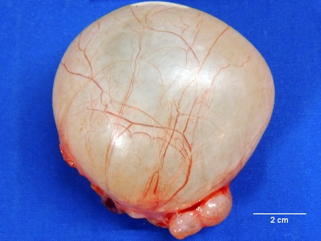 Webpathology.com: A Collection of Surgical Pathology Images