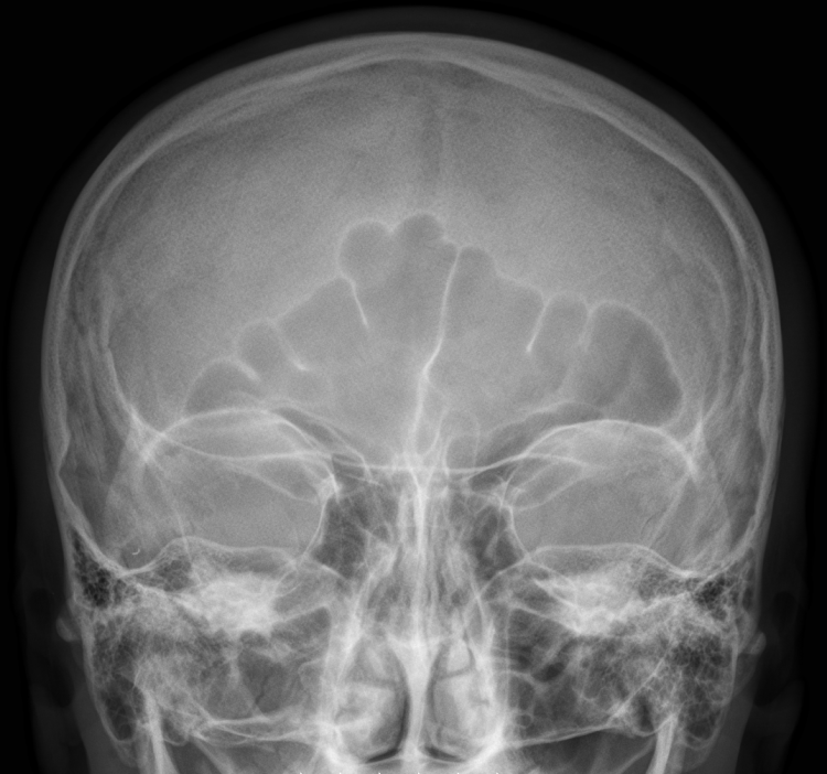 File:Sinus frontalis X-ray.png - Wikimedia Commons