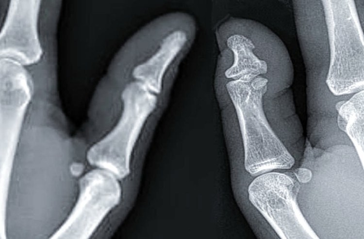 File:X-ray of a normal thumb next to a thumb with Brachydactyly type D.jpg - Wikimedia Commons
