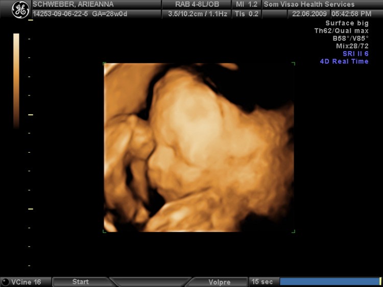 3D Ultrasound - Ianiv & Arieanna - Flickr