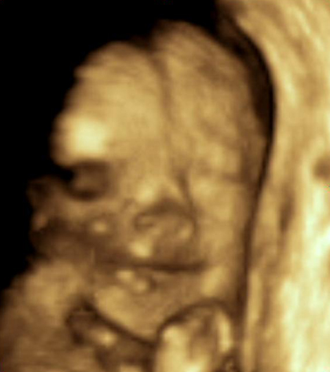 File:3Dultrasound 24weeks +3.jpg - Wikimedia Commons