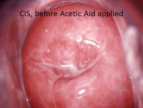 Utility of Colposcopy: Comparison of Colposcopic Abnormality with Histology and Cytology, with Colposcopic Findings Focusing on the Lesion in Cervical Canal - IntechOpen