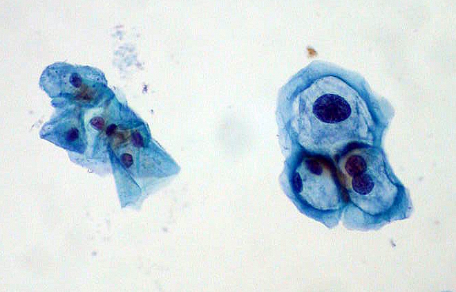 File:ThinPrep Pap smear HPV.jpeg - Wikimedia Commons
