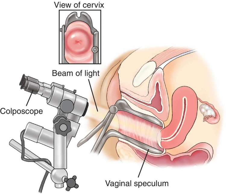 Colposcopy - Colposcopy Biopsy, Results, HPV, Side Effects