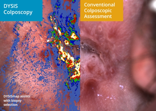 Colposcopy - DYSIS Medical