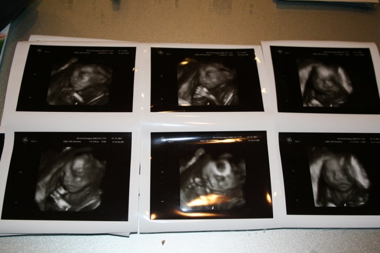 24 weeks - 3d ultrasound - jencu - Flickr