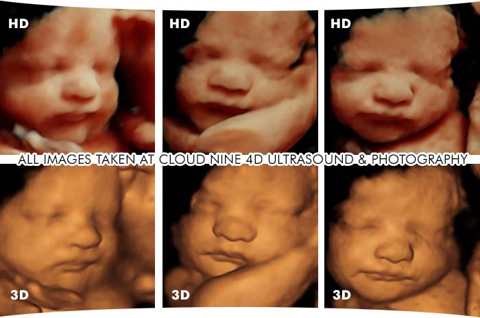 3D ultrasound / 4D Ultrasound / HD Ultrasound - Chattanooga, TN