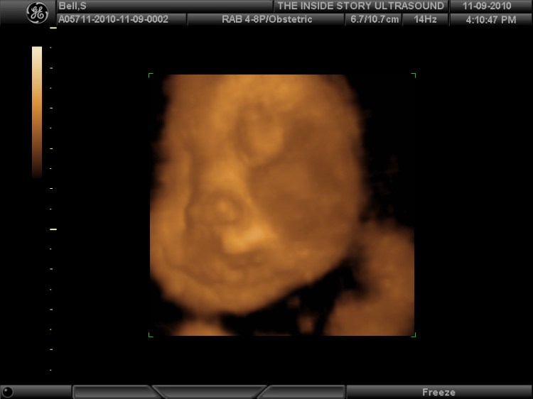File:3D Ultrasound (5164126570).jpg - Wikimedia Commons