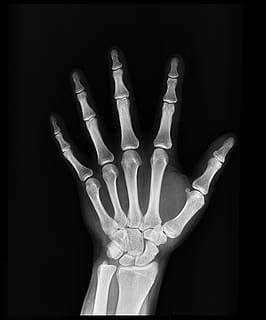 HD wallpaper: bone x-ray result, radiography, diagnosis, anatomy, injury, radiology - Wallpaper Flare