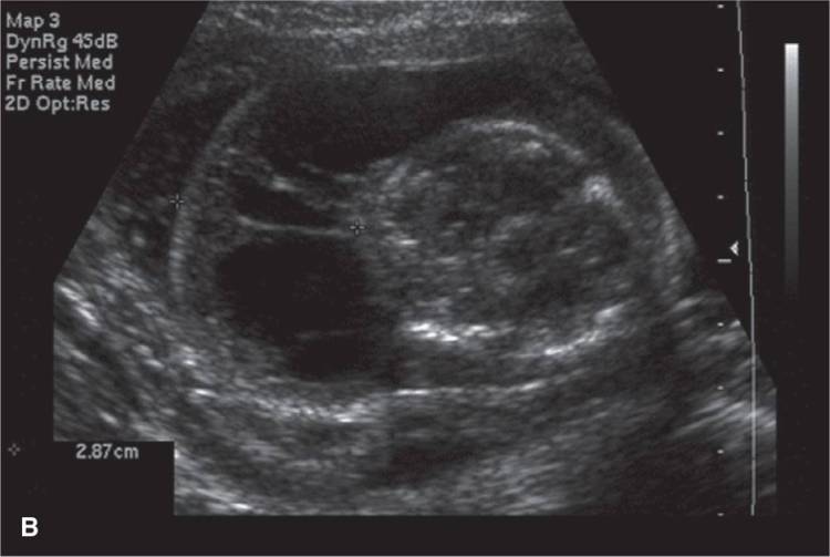 gynecological ultrasound